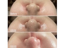 コルギ デ コガオ(KORUGI de KOGAO)/LAMINATION PEEL