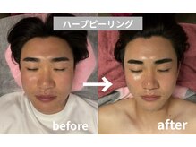ゼロミリメートル(0mm)の雰囲気（ハーブピーリング¥8,800～【毛穴/角質ケア/小顔マッサージ】）