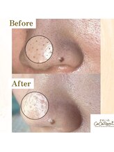 キレイノココロミ(きれいのCoCoRomi)/毛穴エクストラクションtete式