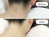 【IPL脱毛】うなじ＋背中｜まとめて脱毛｜２箇所｜90分　￥13200→￥7800