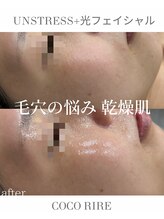 ココリール/クリスティーナ×光フェイシャル