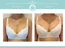 美人バスト 南森町店/バストアップ◇症例◇