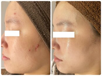 フルリールボーテ(Fleurir Beaut)/ニキビ毛穴