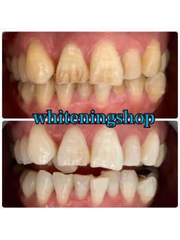 ホワイトニングショップ 武蔵小杉店/武蔵小杉ホワイトニング美白ケア