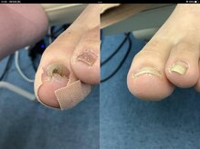 【巻き爪/深爪/フットケア】巻き爪本舗　津田沼店/この爪も心配ありません！