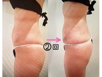 ビューティースパ/エンダモロジーアライアンス2回