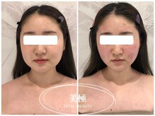 美極 銀座店/銀座/小顔コルギ/小顔矯正