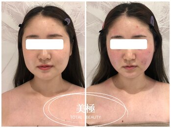 美極 銀座店/銀座/小顔コルギ/小顔矯正