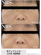 キュー(cue)/光フェイシャル2週間に1度