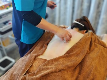 はりキュア(はりCure)/吸い玉療法（走罐）