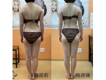 ピールオフ(peel off)の雰囲気（全身１回の施術後の変化です☆）