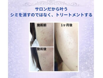 サロンファーストタッチ(Salon First Touch)/ビフォーアフター　シミケア