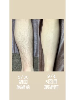レイシー(Resy)/