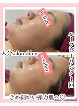 サロンシャイン(Salon Shine)/ハーバルピールレベル4