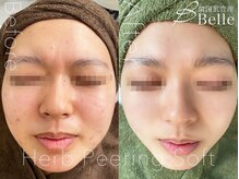 ベル 桜木町(Belle)/ハーブピーリング｜ニキビケア