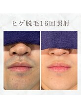 ボゴス(BOGOSS)/ヒゲ脱毛16回照射