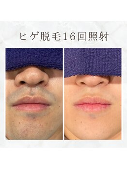 ボゴス(BOGOSS)/ヒゲ脱毛16回照射