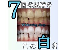 ホワイトニングショップ 長崎店/ホワイトニング
