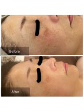 ルーエ(Ruhe)/シミケア1ヶ月