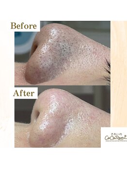 キレイノココロミ(きれいのCoCoRomi)/毛穴エクストラクションtete式