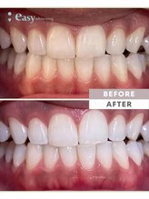 イージーホワイトニング 新宿店(easy whitening)/喫煙者も施術OK！【新宿駅近】