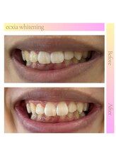 エクシアホワイト 新宿御苑店(ecxia white)/ホワイトニングビフォーアフター