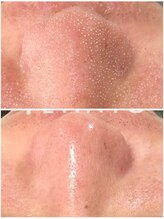 リラ(RILA)/肌育毛穴洗浄