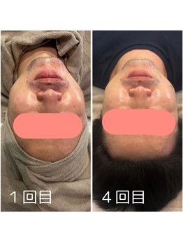 モンド 駒込店(monde)/ハーブピーリング