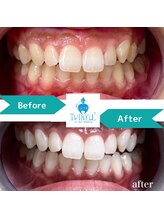 ティンクルホワイト 上尾店/ホワイトニングBefore After