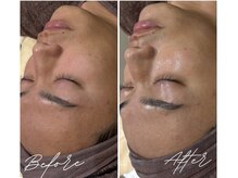 シュウア(SyuA)/メンズ韓国水光肌ピーリング