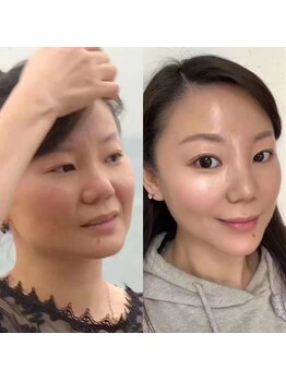 ブリエ(Brille)/水光肌ダイヤモンドピーリング