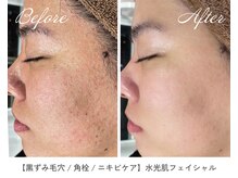 サラスヴァティー(SARASVATI)/肌荒れ/肌のザラつき★20代女性