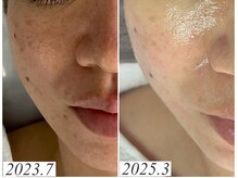 レイ(Rey)/オーダーメイド肌質改善コース