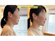 エヴァ ナゴヤ(EVA nagoya)/あご下のたるみ