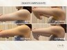 【セルリバースボディコントア】二の腕の落ちにくい脂肪に◎