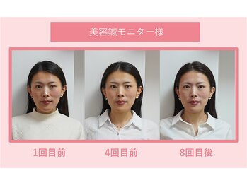 グリーンノア鍼灸院/40代女性美容鍼1ー8回目の変化