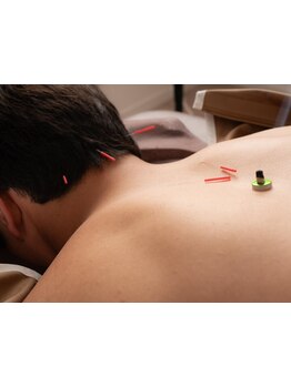 鍼灸施術を受けたい