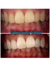 ホワイトニングショップ 武蔵小杉店/武蔵小杉ホワイトニング美白ケア