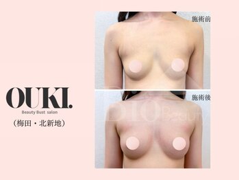 オウキ 梅田北新地(OUKI.)/バストアップ結果写真