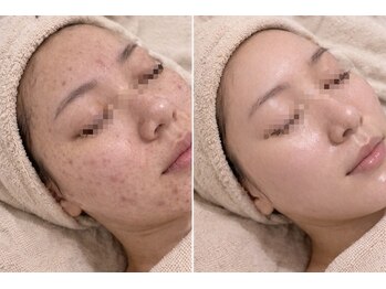 トータルサロンアイビーシー(トータルサロンIBC)の写真/鏡を見るのが嫌だった肌から卒業！素肌に自信が持てる毎日へ導く本格肌質改善サロンです。お気軽にご相談を