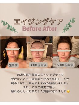 ミモザ/エイジングケアビフォーアフター