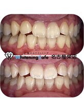 ホワイトニングカフェ 名古屋栄店(WhiteningCafe)/学割8回コース症例写真