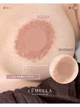 エルビービュティーサロン(LB BEAUTY SALON)/【ルメラ乳輪】実績数関西1★