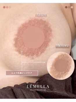 エルビービュティーサロン(LB BEAUTY SALON)/【ルメラ乳輪】実績数関西1★