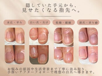 エムアール(MR)の写真/【自爪育成症例モニター9月募集予定】ジェルで隠すのではなく、自分史上最高に健康で美しい自爪を目指せる