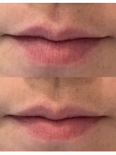 リムビューティー 自由が丘(RymBeauty)/唇もピーリング/ ダクトピール