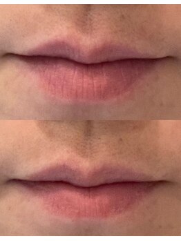 リムビューティー 自由が丘(RymBeauty)/唇もピーリング/ ダクトピール