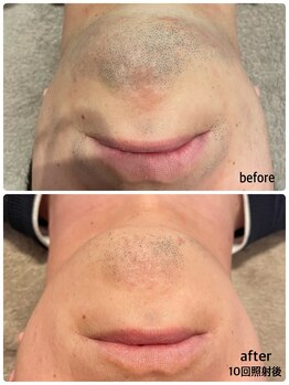 エピベル(Epibelle)/