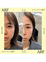 アーフ(ARF)/エクソリフト