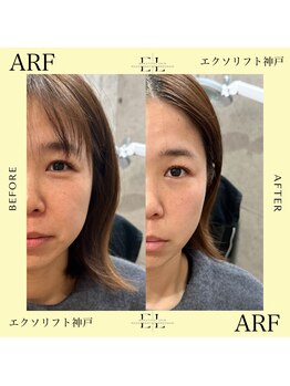 アーフ(ARF)/エクソリフト